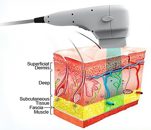 skin tightening, skin lifting, wrinkle removal, fat freeze, weight loss, acne, sun damage, pigmentation, eyebrow lift, intensive collagen production 